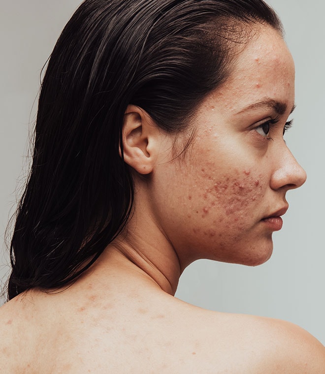 Young woman with a severe case of acne on her cheek