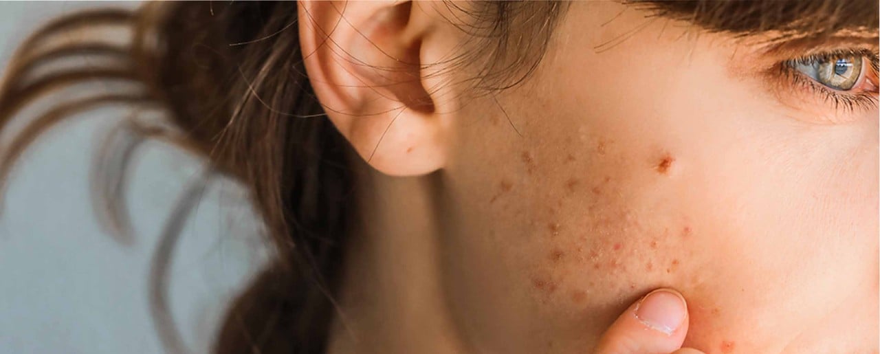 hjælp Misforståelse afskaffet Retinol for acne scars: Does it help?