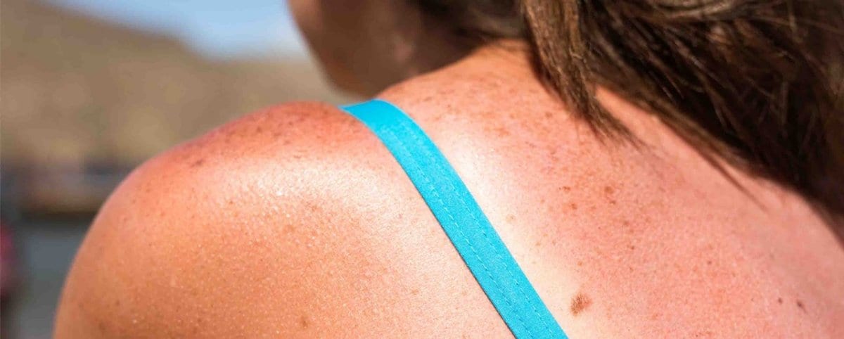 How To Treat Sunburn - 7 Ways To Get Rid Of Sunburn