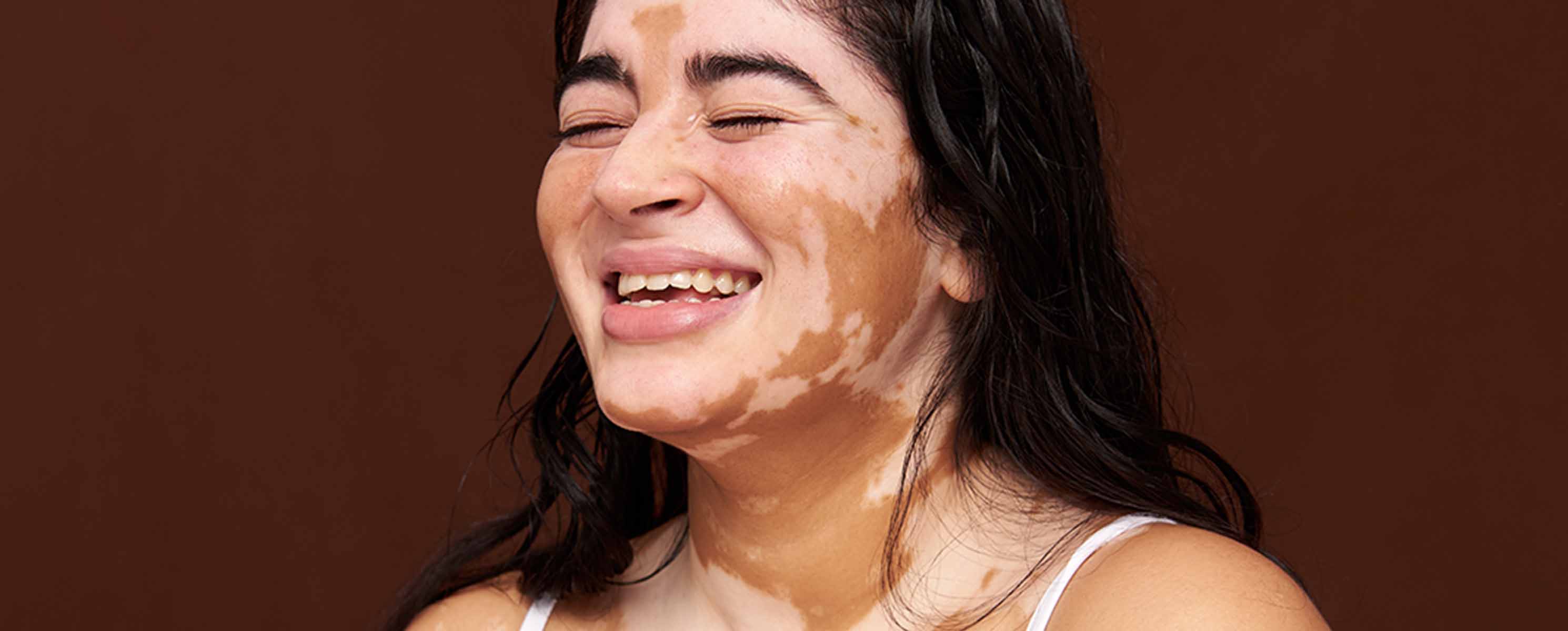 Young woman with vitiligo smiling