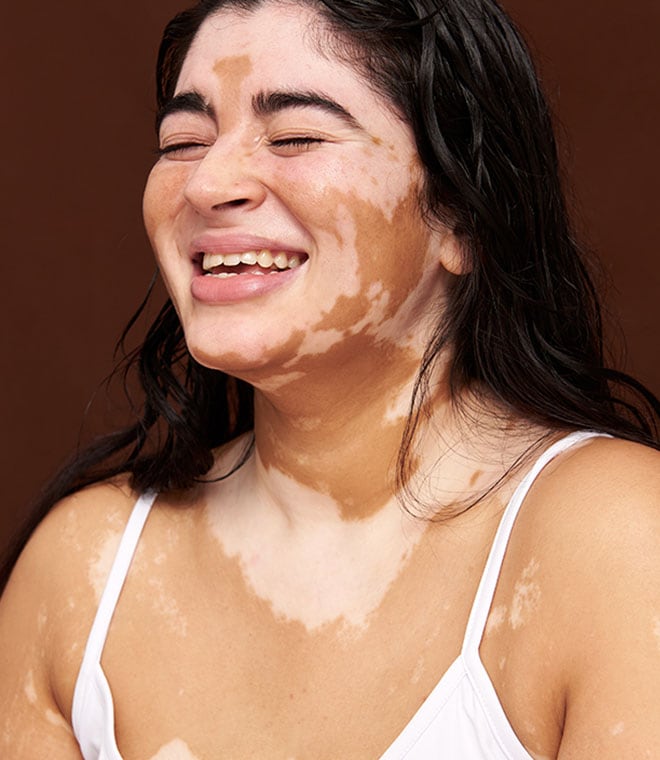 Young woman with vitiligo smiling