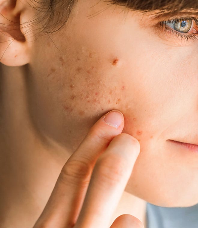 White teenage boy inspecting acne scars on his cheek