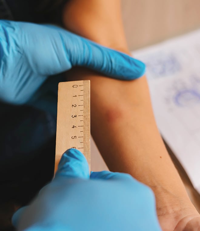 Doctor checking TB test site on person's arm