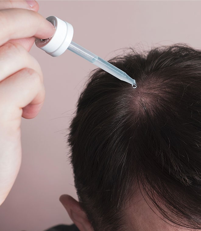 Man with dark hair putting drops on a bald spot