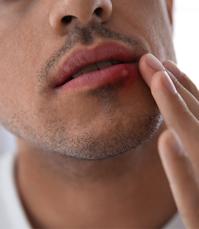 Young man with a cold sore on his bottom lip