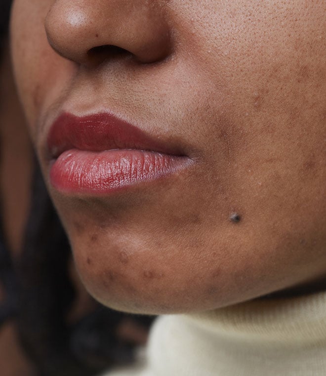 Acne scars on a black womans face