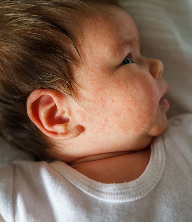 Baby with eczema rash on its face
