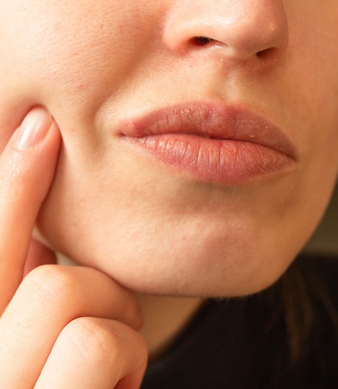 Woman checking out a cold sore on the corner of her lip