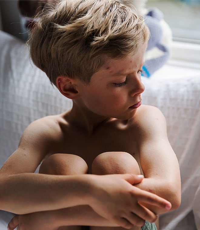 Young boy with sores on his face and shoulders