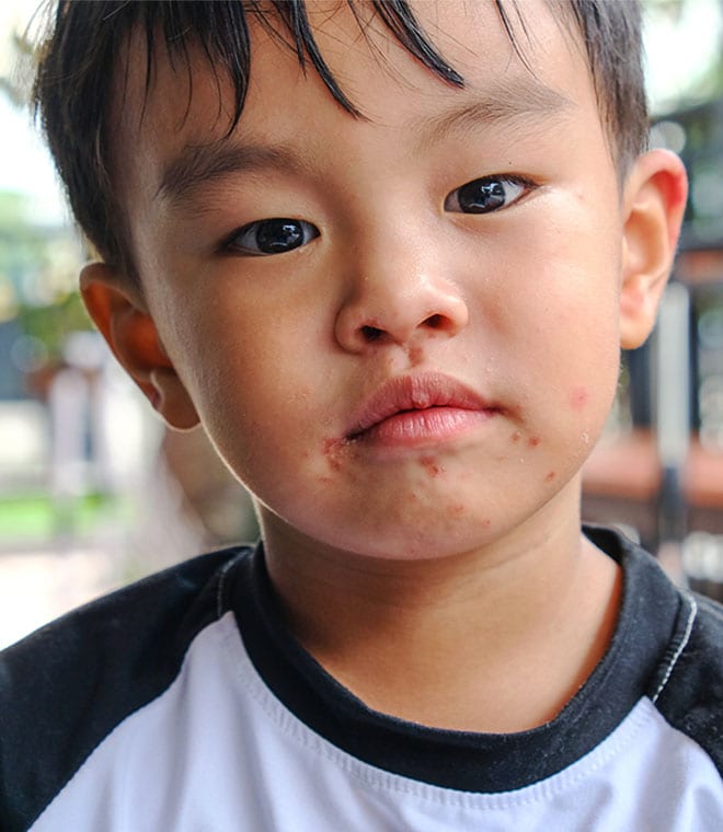 Young Asian boy with sores around his mouth