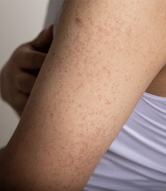 Tan woman's arm with keratosis pilaris