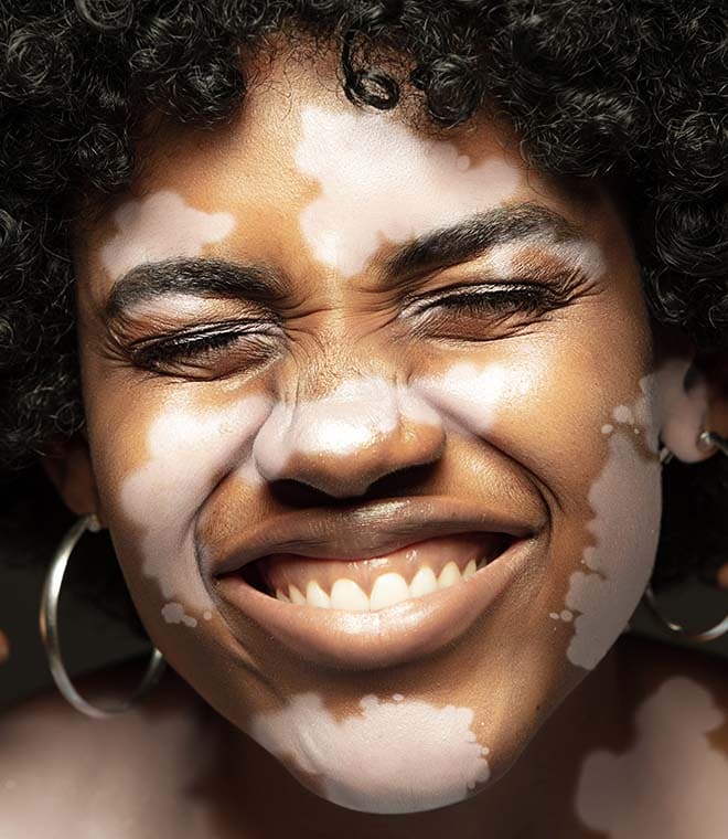 Young black woman with vitiligo