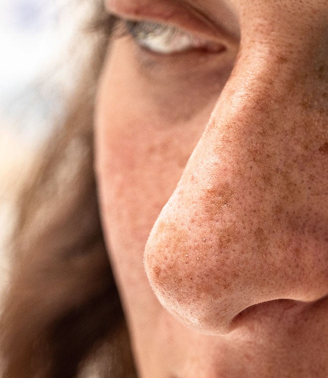 Dark spots on a white womans nose