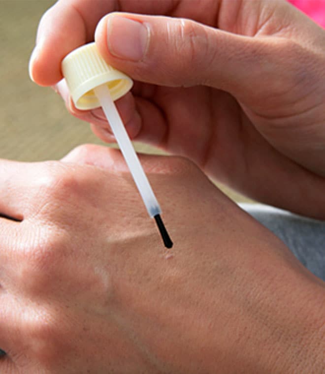 Applying a liquid treatment to a hand wart