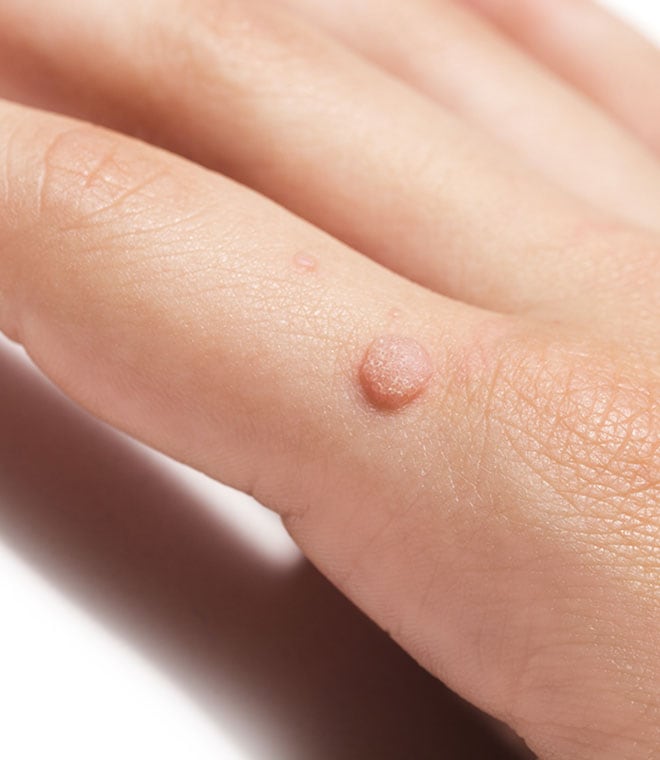 White woman with wart on her finger