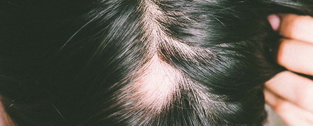 White person with black hair showing a bald spot