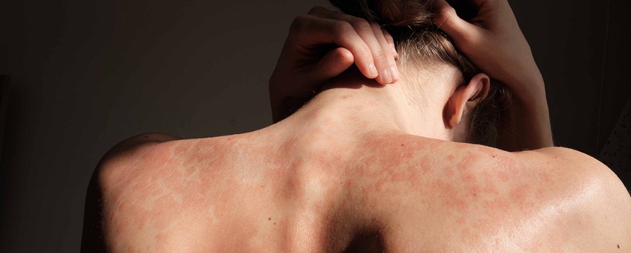 Young white woman showing rash on her back