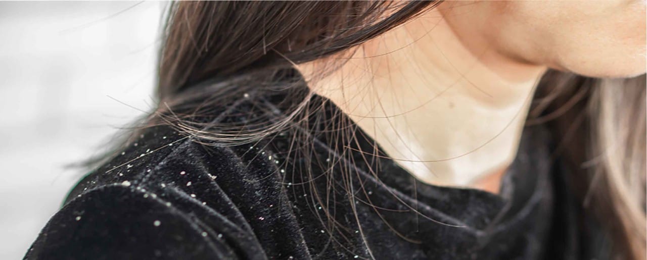 Woman with dandruff flakes on black shirt