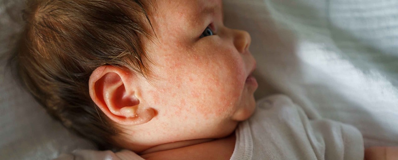 Baby with eczema rash on its face