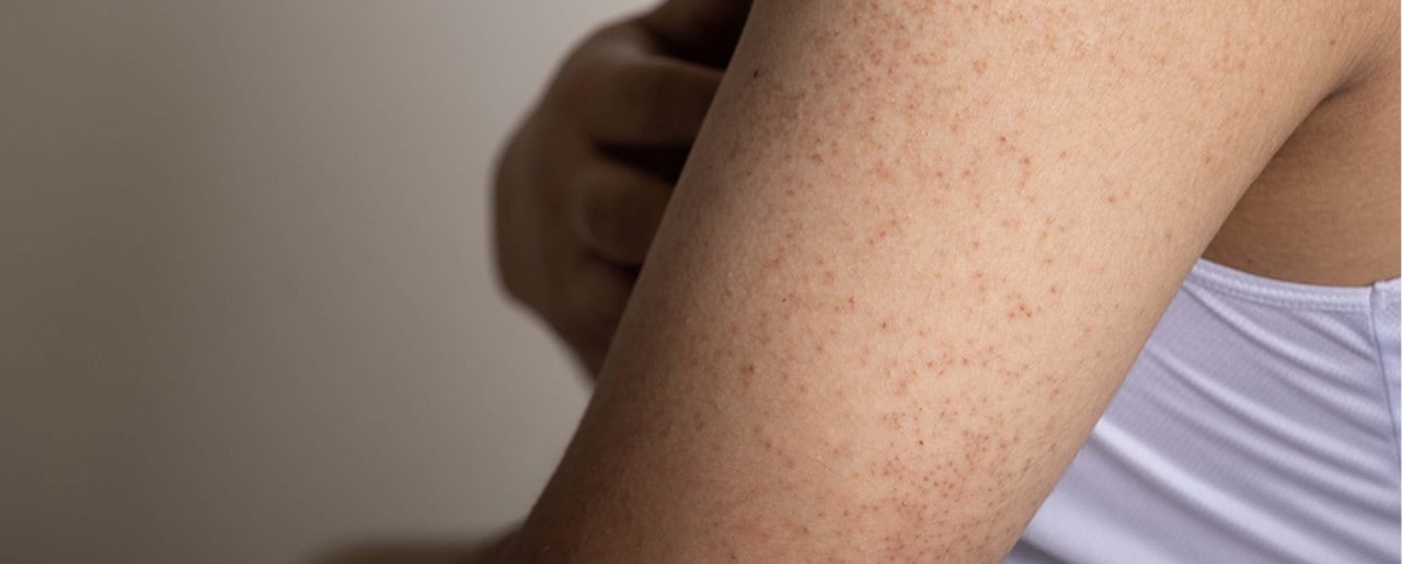 keratosis pilaris arms how to get rid