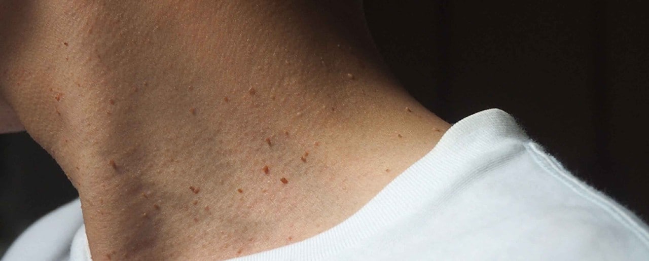 Skin tags on person's neck