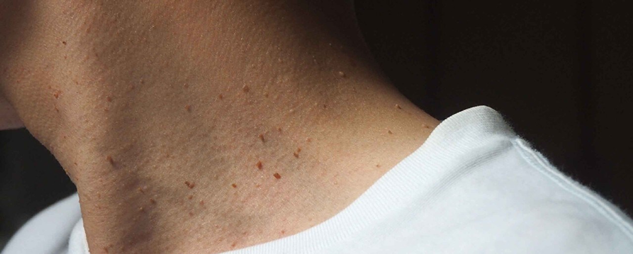 Skin Tag Vs Wart What s The Difference 