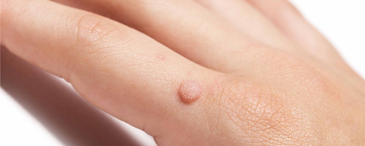 Warts on the hands: Causes, symptoms and treatments