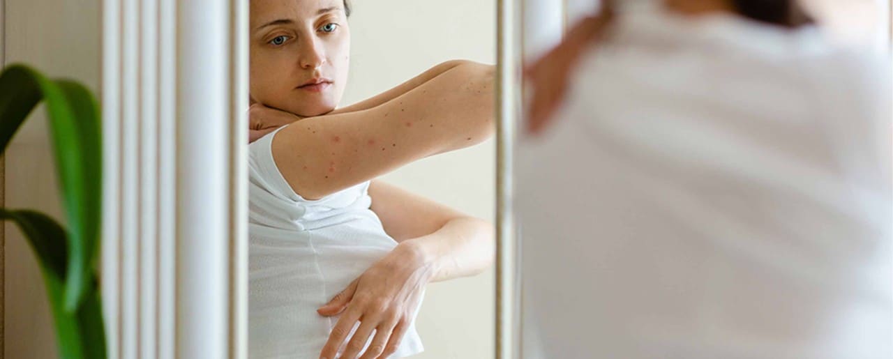 Young white woman examining her eczema in the mirror